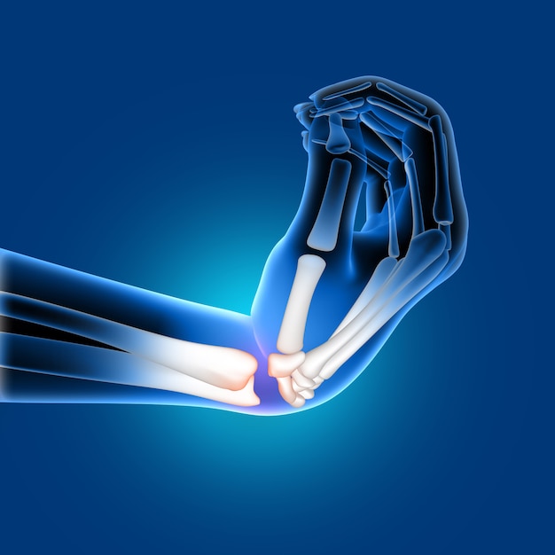 3D medical image of a painful bent wrist