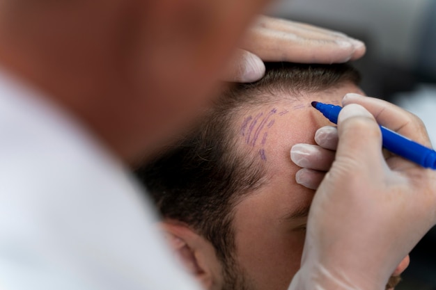 Adult male doing a follicular unit extraction