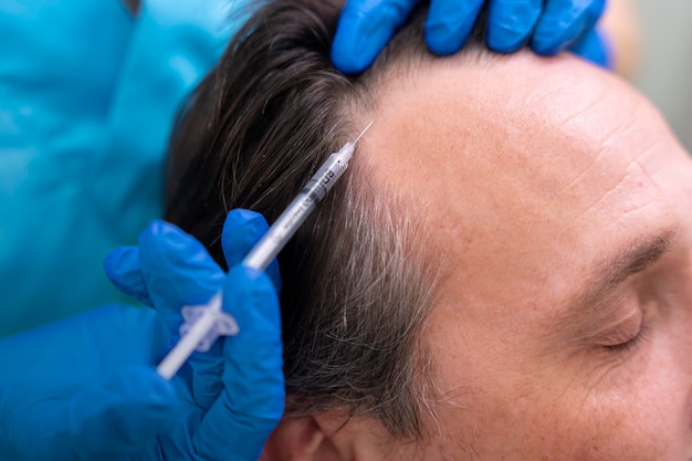 Adult male getting a hair loss treatment