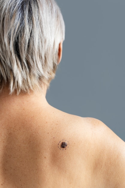 Back view woman with melanoma