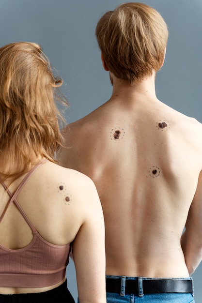 Free photo back view young people with melanoma