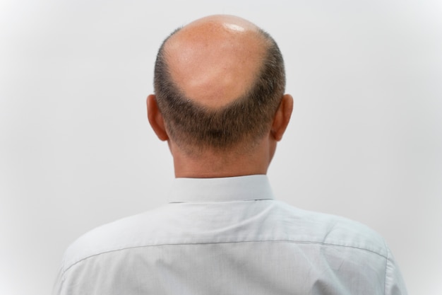 Free photo bold man needing a follicular unit extraction