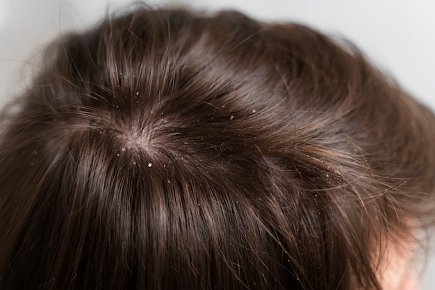 Close up on hair with dandruff