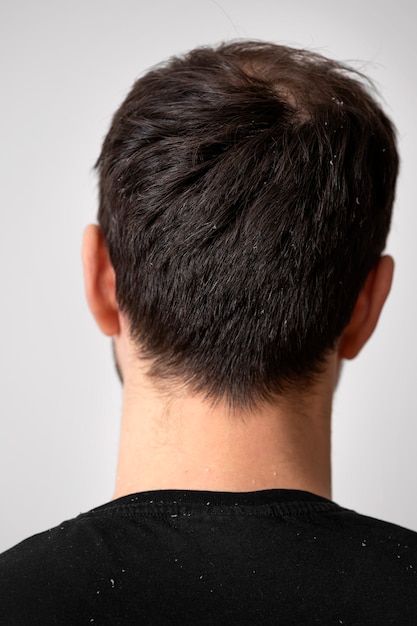 Close up man with dandruff problems back view