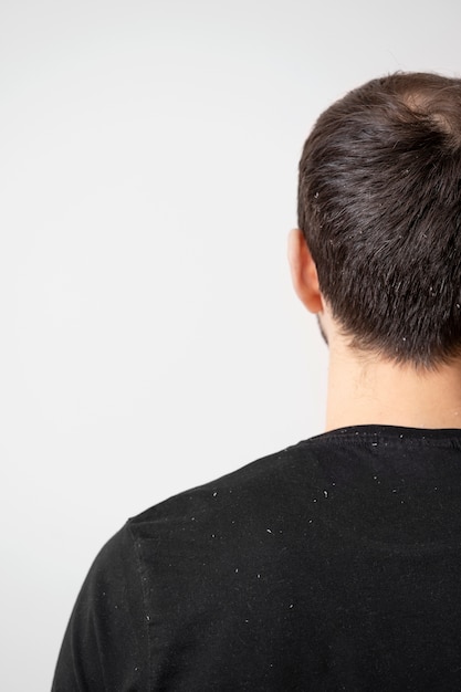 Close up man with dandruff