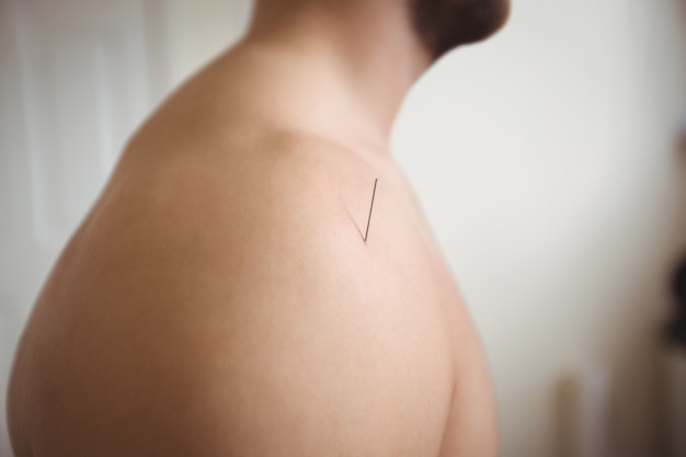 Free photo close-up of a patient getting dry needling