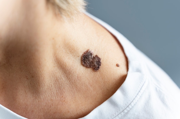 Free Photo close up patient with skin disease