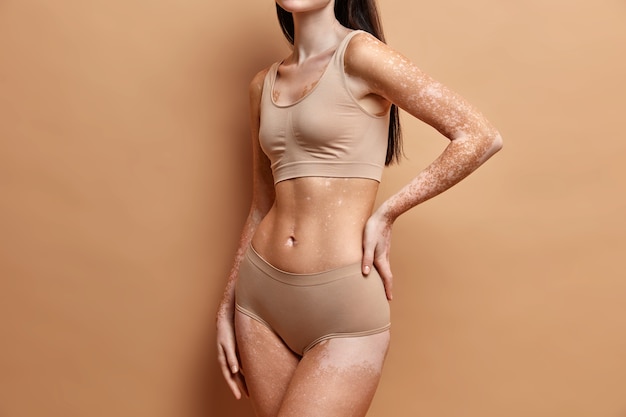 Close up on slim woman with vitiligo skin