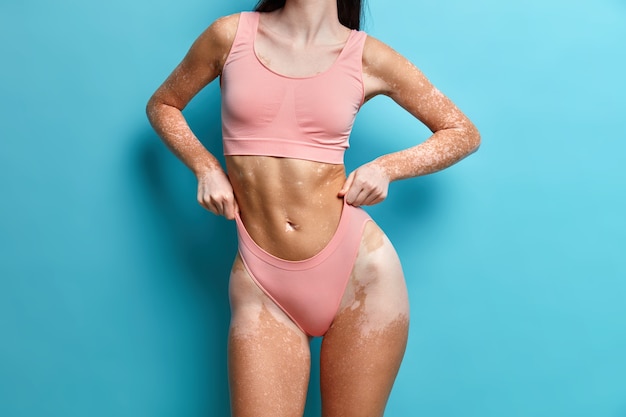 Free Photo close up on slim woman with vitiligo skin