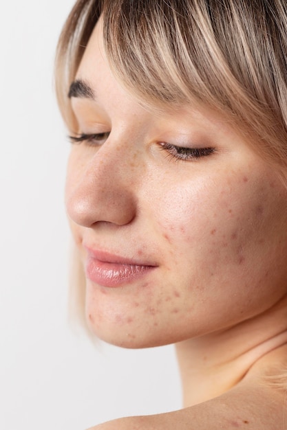 Free photo close up woman with acne posing