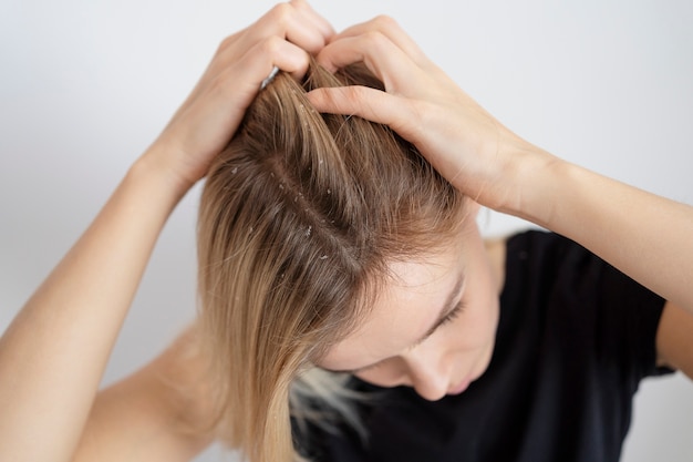 Free photo close up woman with dandruff issues