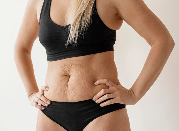 Close up woman with stretch marks