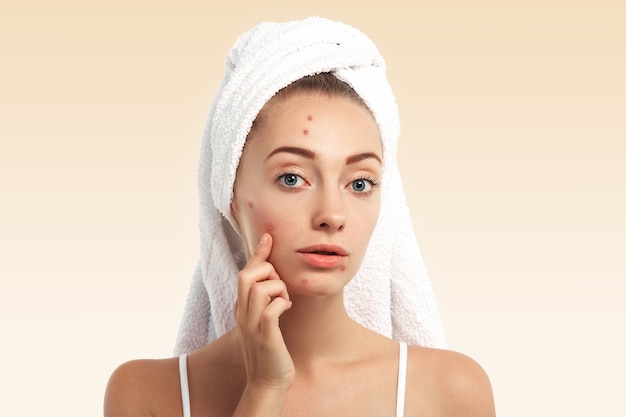 Closeup of young woman with towel on head and pimples on face