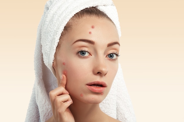 Free Photo closeup of young woman with towel on head and pimples on face