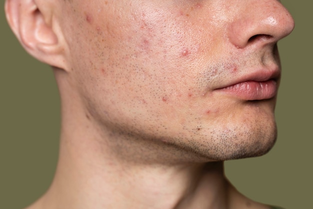 Free Photo confident handsome man with acne