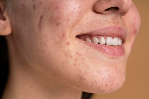 Free photo confident young woman with acne close-up