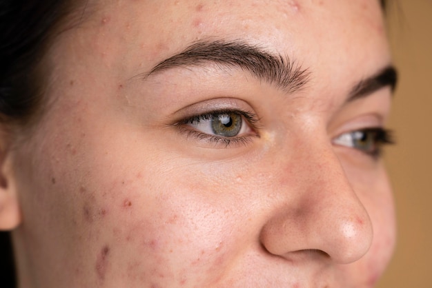 Confident young woman with acne close-up