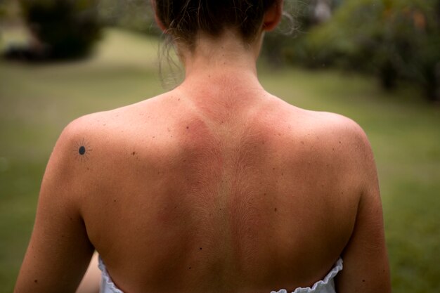 Free Photo details of a woman's sunburn skin from the beach sun