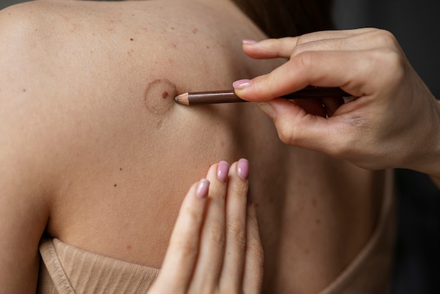 Female doctor diagnosing a melanoma on the body of a female patient