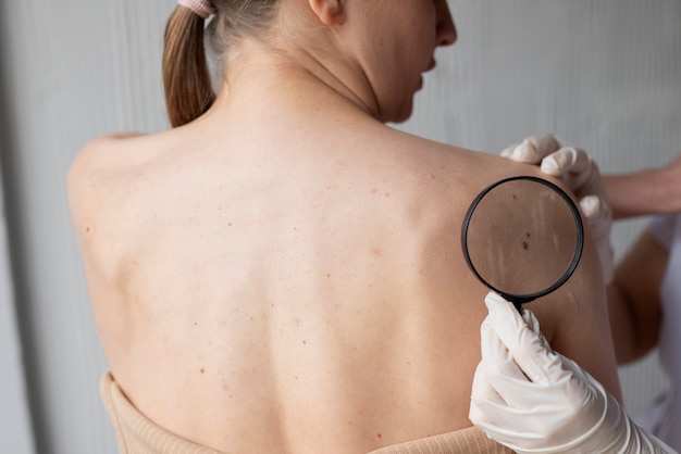 Female doctor diagnosing a melanoma on the body of a female patient