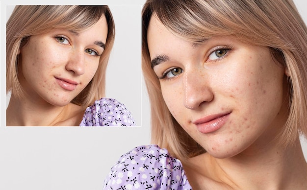 Free Photo front view woman with acne issues