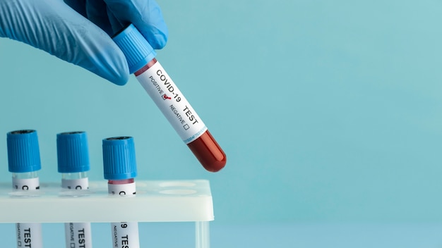 Hand with protective gloves holding a blood samples for covid test