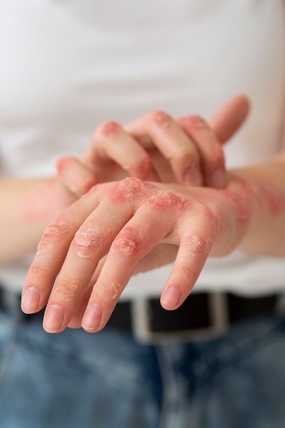 Hands of patient suffering from psoriasis