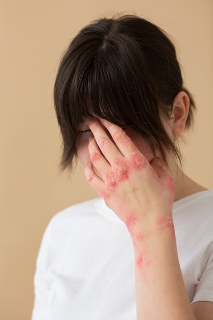 Free Photo hands of patient suffering from psoriasis