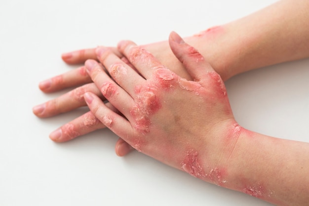 Free Photo hands of patient suffering from psoriasis