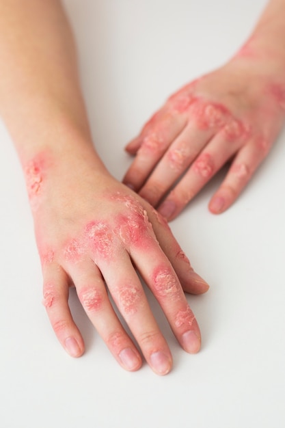 Hands of patient suffering from psoriasis