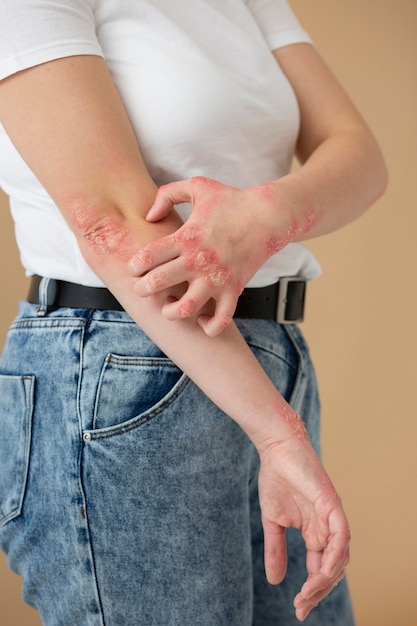 Free Photo hands of patient suffering from psoriasis