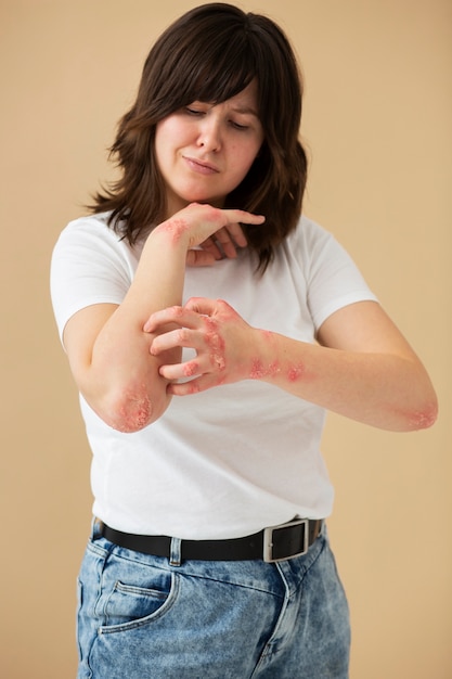 Free Photo hands of patient suffering from psoriasis