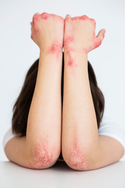 Free photo hands of patient suffering from psoriasis