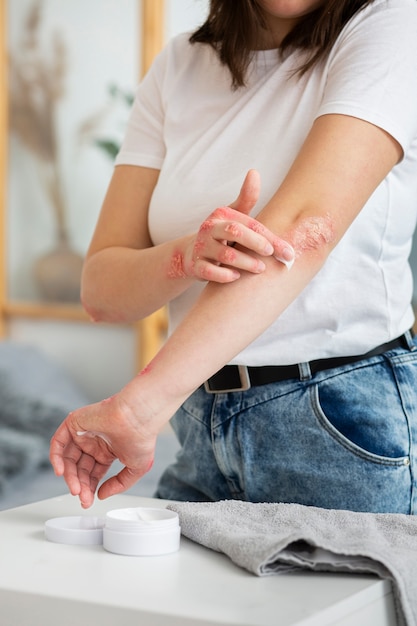 Hands of patient suffering from psoriasis