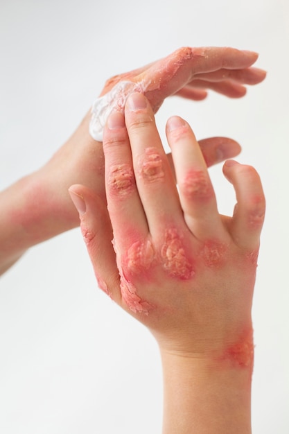 Free Photo hands of patient suffering from psoriasis