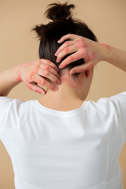 Hands of patient suffering from psoriasis