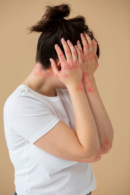 Free photo hands of patient suffering from psoriasis