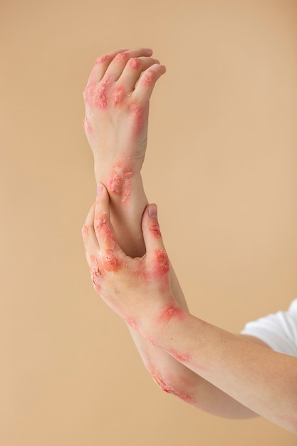 Free Photo hands of patient suffering from psoriasis