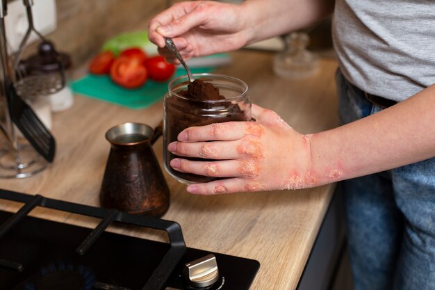 Hands of patient suffering from psoriasis