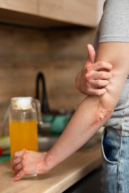 Free Photo hands of patient suffering from psoriasis