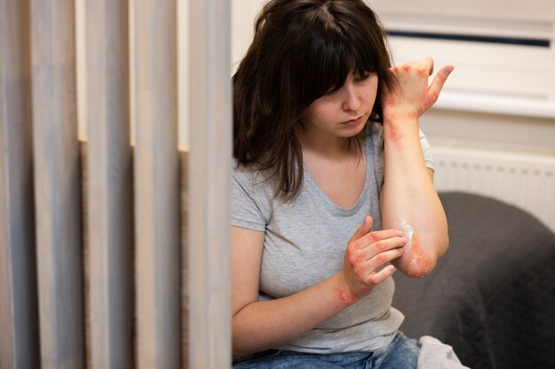 Hands of patient suffering from psoriasis