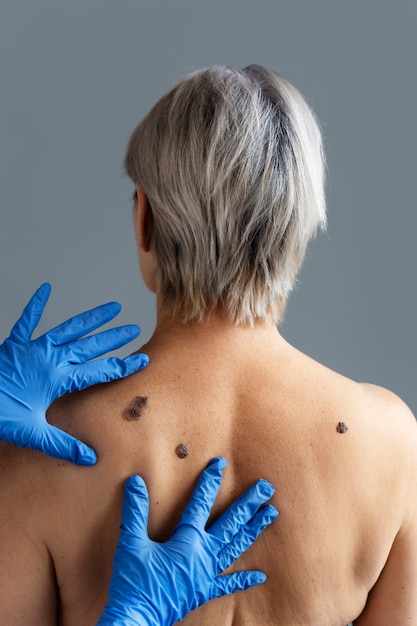 Free photo hands with gloves touching skin with melanoma