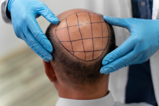 Male going through a follicular unit extraction process