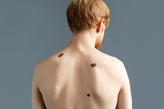 Medium shot young man with melanoma