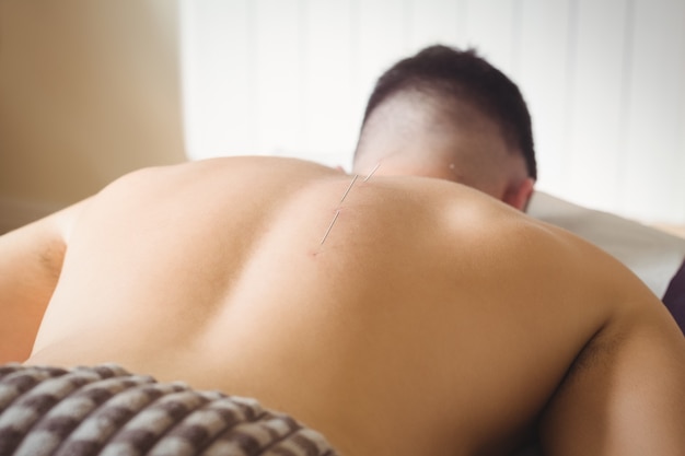 Free photo patient getting dry needling on back