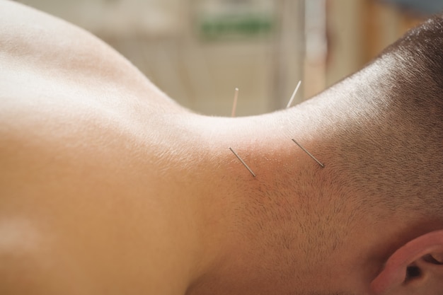 Free photo patient getting dry needling on neck