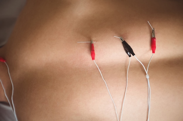 Free photo patient getting electro dry needling on his back