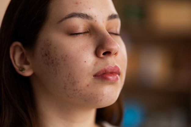 Free photo person dealing with rosacea