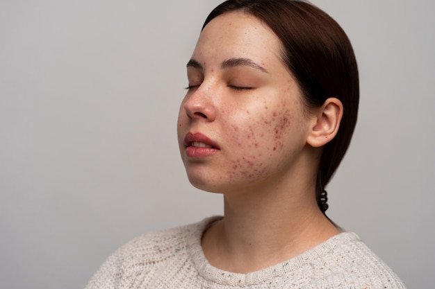 Free Photo person dealing with rosacea