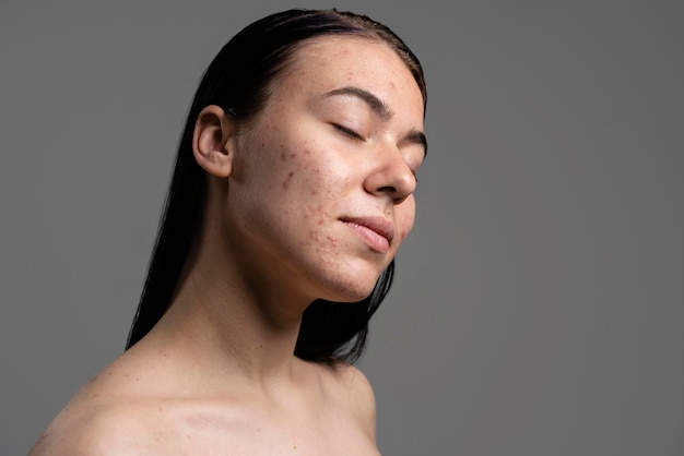 Portrait of beautiful young woman with acne